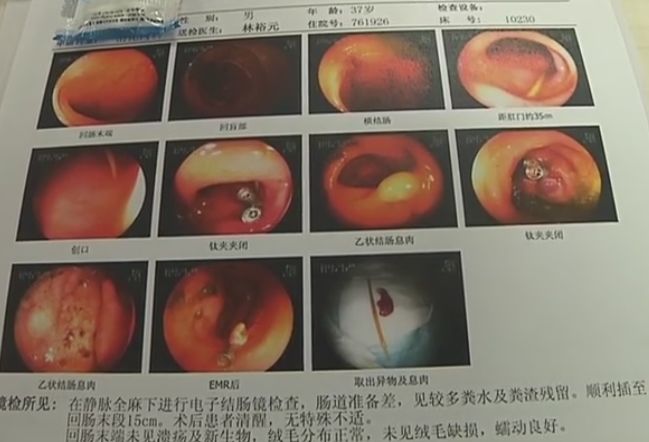 真坑爹喝了一杯水爸爸差点肠穿孔居然是孩子干的