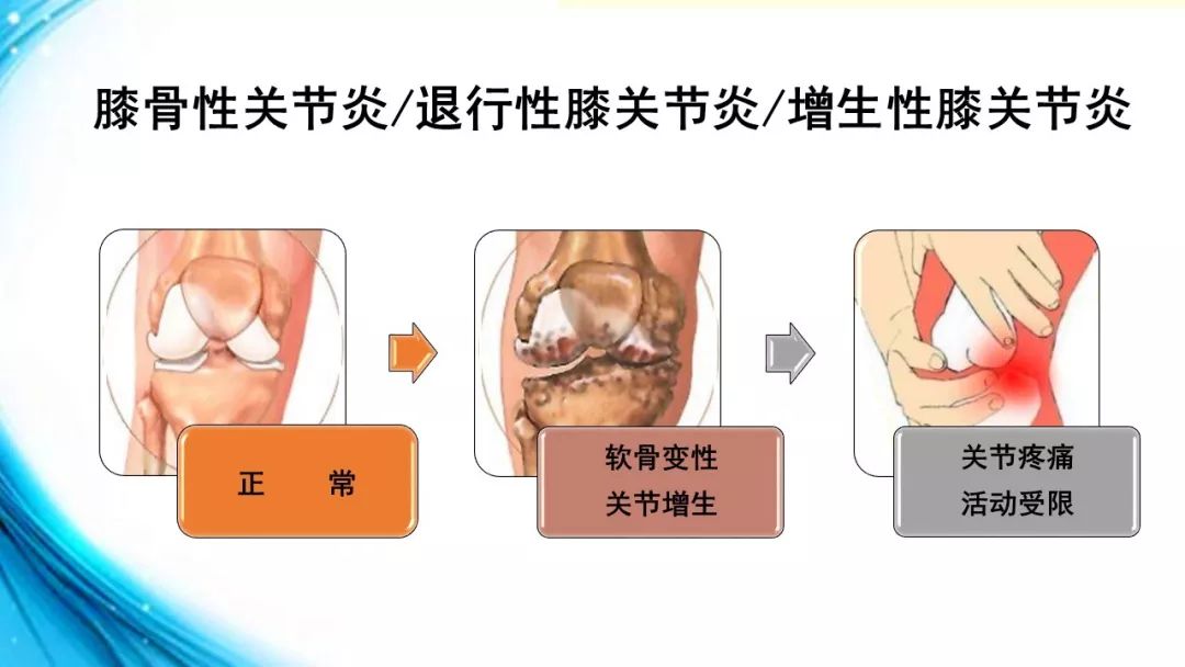 膝骨性关节炎是由于膝关节的退行性改变和慢性积累性损伤,引起的膝