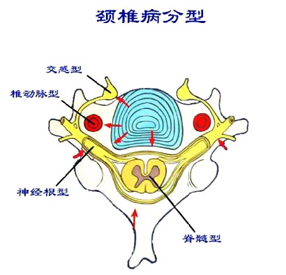 【组图】脊髓型颈椎病的致病因素及常见症状