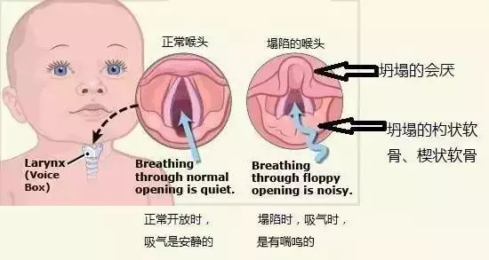 喉咙出气有鸣声怎么办