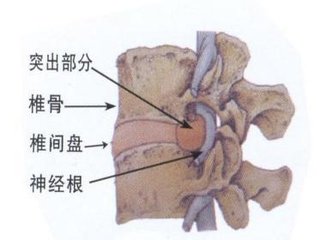 治疗腰间盘突出的最佳偏方的药锻炼方法