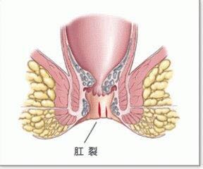 外痔出血应该怎么办