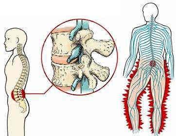 四,下肢放射痛:在腰椎间盘突出症初期的时候,疼痛首先在臀部开始