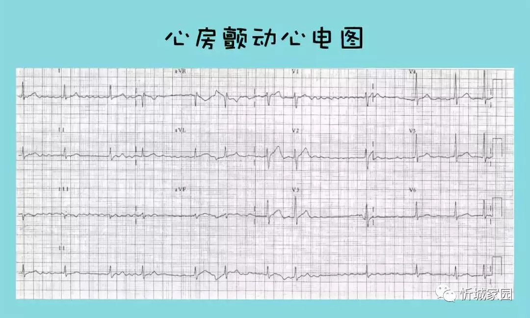 ▽ 而室颤虽说跟房颤一样都是"颤动",但由于发生的部位不一样,导致