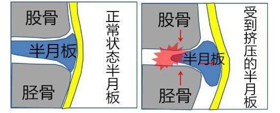 膝盖摔伤肿了怎么办