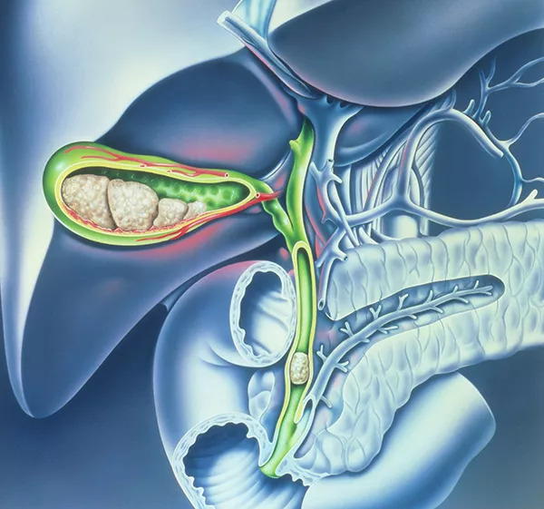 胆疼未必是胆囊结石作怪,这个结石更可怕