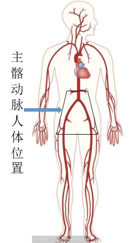 市二院血管外科手术专题系列报道(三):主髂动脉闭塞的