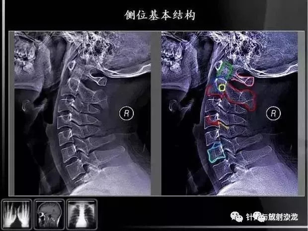 教你如何看懂颈椎x线片阅片的基础知识