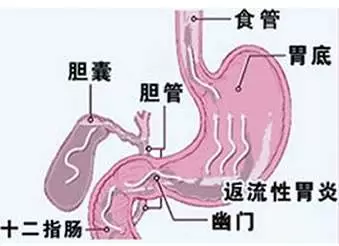 胆摘除的人口_胆摘除照片