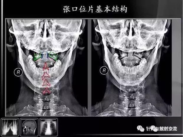 教你如何看懂颈椎x线片阅片的基础知识