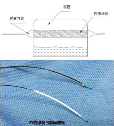 对吻球囊扩张/药物球囊贴敷 对吻裸支架/对吻覆膜支架植入