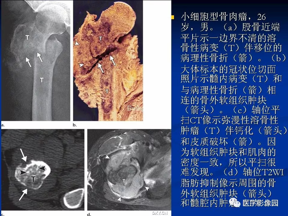 非传统型骨肉瘤影像学特点 | 影像天地