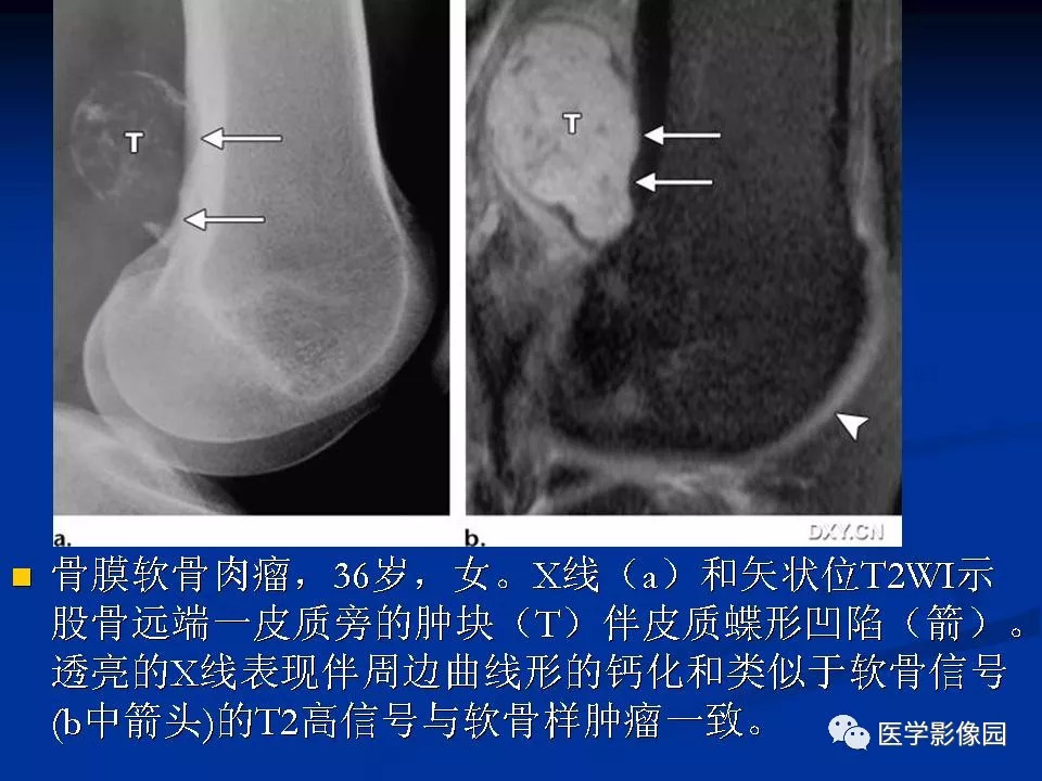 非传统型骨肉瘤影像学特点 | 影像天地