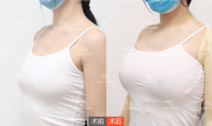 通过自体脂肪丰胸,现在已经达到c罩杯,并且矫正了胸下垂的情况