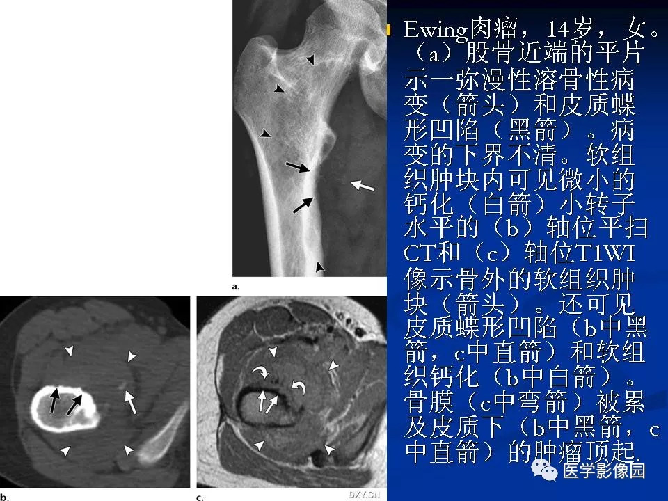 非传统型骨肉瘤影像学特点 影像天地