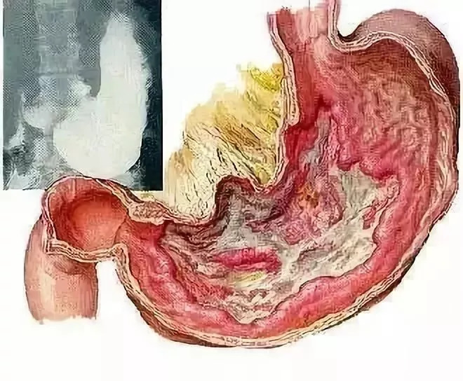 胃溃疡——一种离癌症非常近的溃疡病