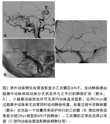 硬脑膜动静脉瘘治疗进展及260个血管内治疗的硬脑膜动