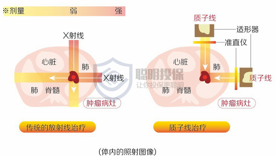 质子重离子治疗,是神器or神话?哪些保险可以报销?