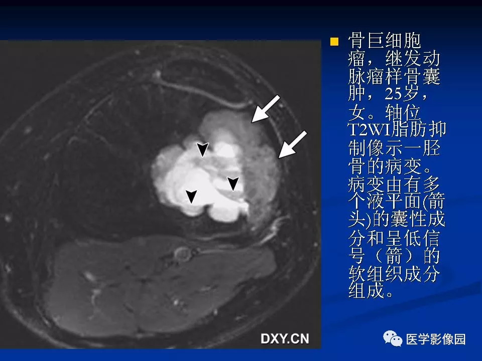非传统型骨肉瘤影像学特点 | 影像天地