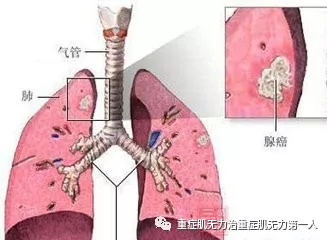 重症肌无力患者一定有胸腺病变吗?