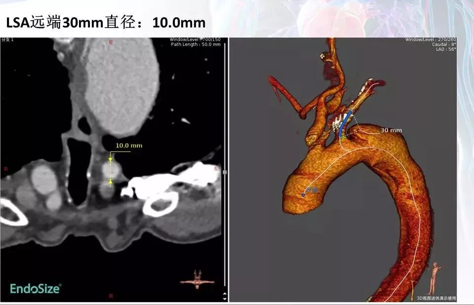 【病例分享】运用castor分支型主动脉覆膜支架系统治疗累及lsa的胸主