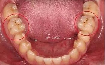 浅龋 这个时候触碰牙齿会有粗糙感,一般采用补牙治疗就可以.