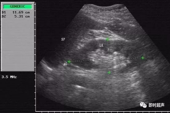 左肾长轴切面,二维成像显示脾脏(sp),左肾(lk)及肾上腺(ag),图中示左
