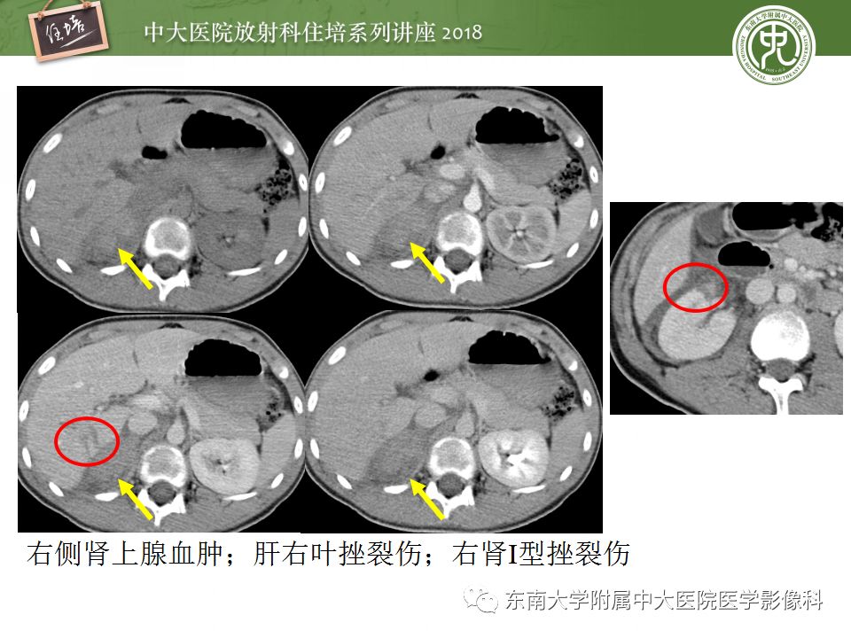 腹膜后外伤的ct表现