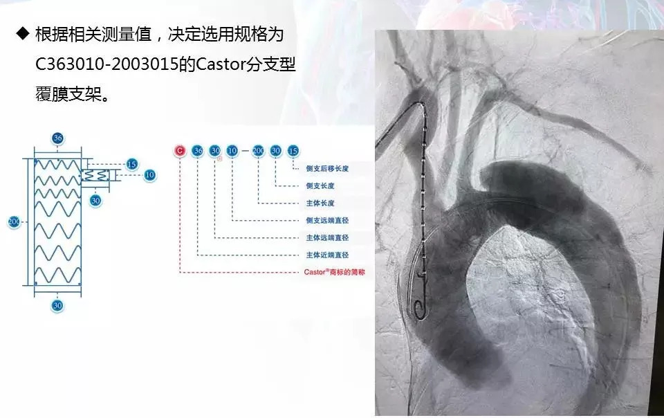 【病例分享】运用castor分支型主动脉覆膜支架系统治疗累及lsa的胸主