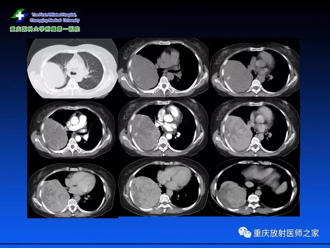 孤立性纤维瘤的影像学诊断及鉴别诊断