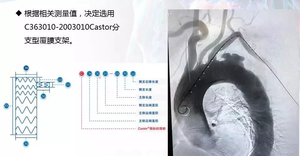 病例分享运用castor03分支型主动脉覆膜支架系统治疗累及lsa的胸主