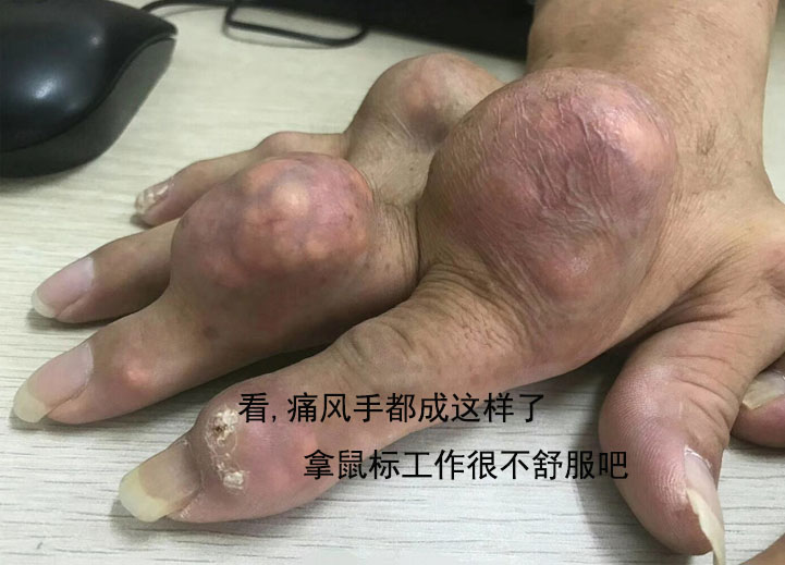 如果您体内已经有按斤计算的尿酸盐结晶