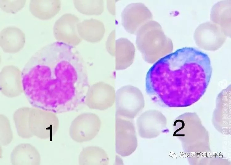 「淋巴细胞(刺激淋巴细胞)」 形态特征:细胞体积较大,胞浆较成熟淋巴