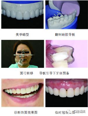 前牙切缘位于下唇干湿交内,正常覆盖量发fv音时中切牙与下唇的