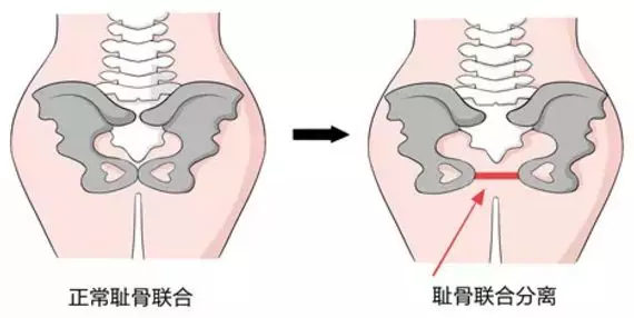 孕妈为什么会"大腿中间"痛,看完你就懂了!_耻骨