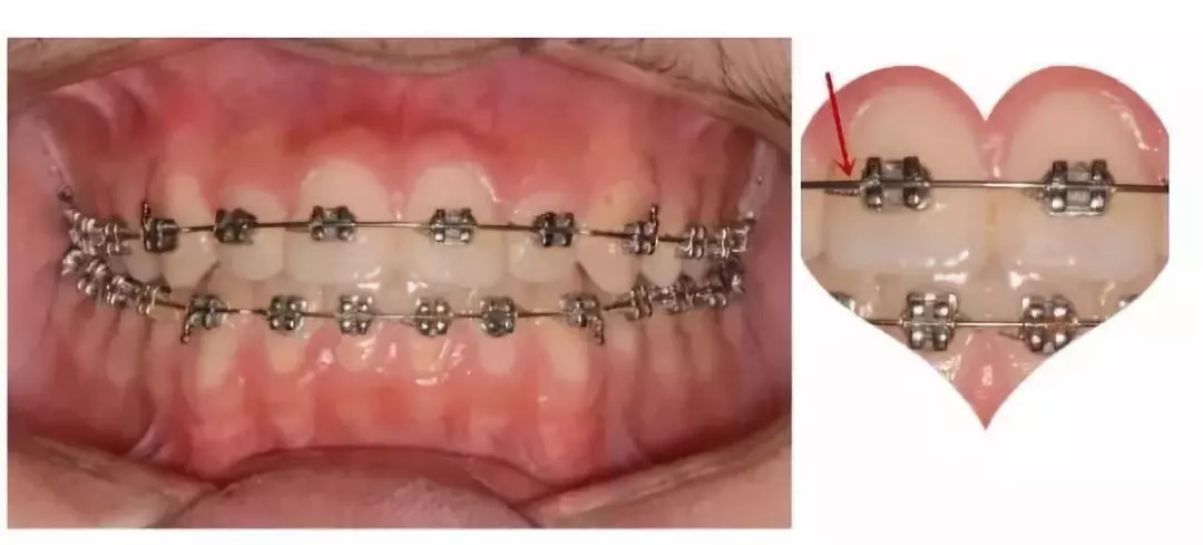 普通金属托槽1首先要说明的是:矫治器只是正畸医生的工具,正畸治疗的