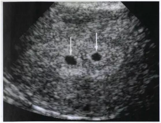 3家医院诊断双胞胎为何只生出一个