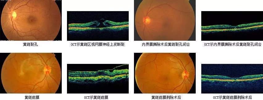 这是由于黄斑部的视细胞非常密集而且如同电线杆一样极有规律,黄斑