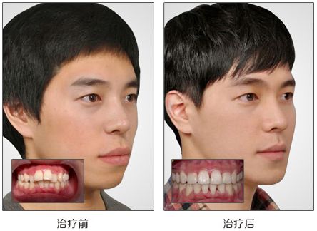 狭隘之见! 矫正牙齿可以改善口腔健康, 顺带美观牙齿.