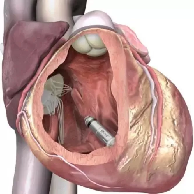 "胶囊型"心脏起搏器究竟神奇在哪里?