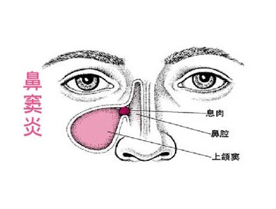 对外来异物引起的鼻窦炎,必须首先做仔细的检查,确定其大小,部位