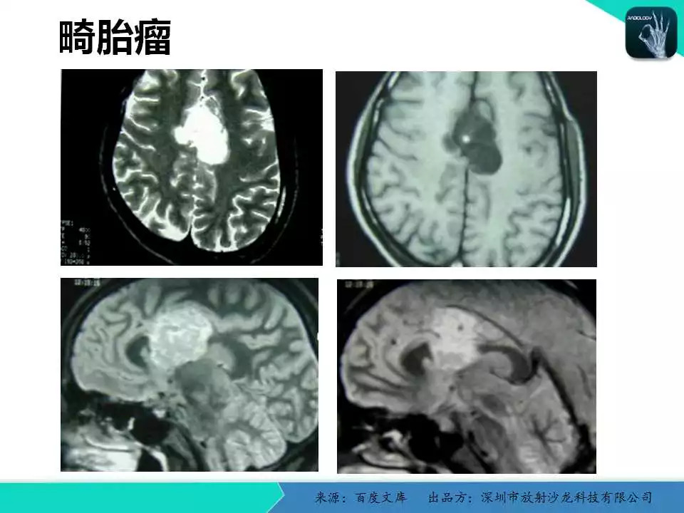 颅脑解剖与常见疾病的ct/mri表现