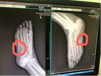 该会员朋友不下心脚趾跖骨骨折已经3个月了,因为是第5跖骨基底部骨折