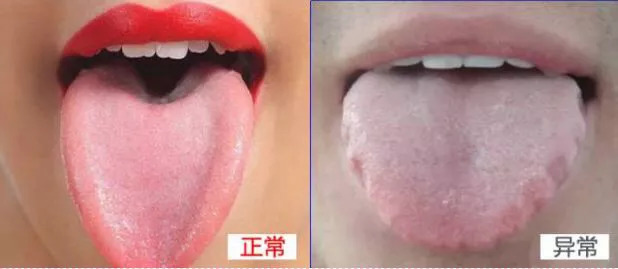 fenleitong.com/舌苔本身光润,在其上表面上,没有牙齿咬合的压印.