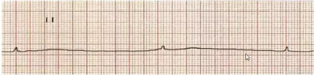 5 mmol/l 后发生心跳骤停,心电图表现为心室扑动) 血清钾>9~10 mmol/l