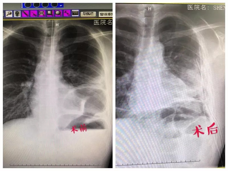 【医闻】复发性膈疝患者重获新生