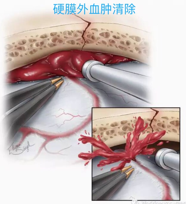 大脑硬膜外血肿,对一侧大脑形成向下和向对侧的压迫,形成脑疝,图