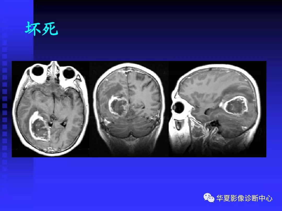 基础必备头颅mri读片知识