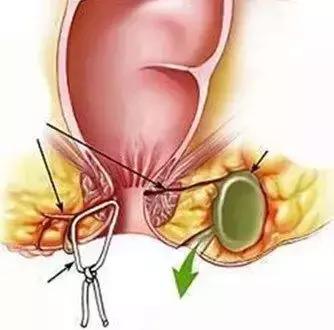 宜昌长航医院|肛周脓肿都有哪些症状和分类?