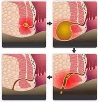 宜昌长航医院|肛周脓肿都有哪些症状和分类?